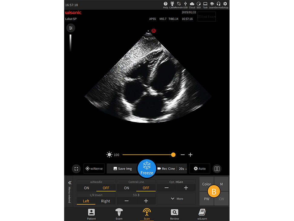 Ultrasound scan showing internal structures with a clear image and additional settings on the Labat system interface