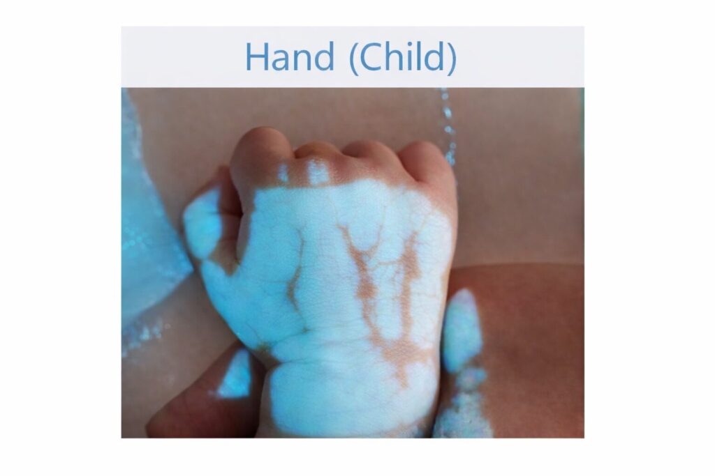 Vein projection on a child's hand using the Amoul Vein Finder VS1400