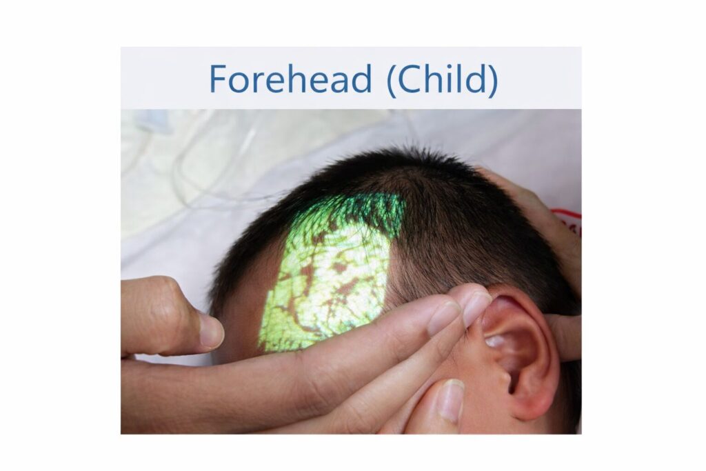 Vein projection on a child's forehead using the Amoul Vein Finder VS1400