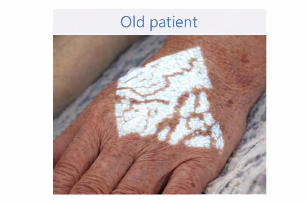 Vein projection on an elderly patient's hand using the Amoul Vein Finder VS1400.